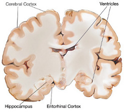 preclinical alzheimer brain: image from ADEAR
